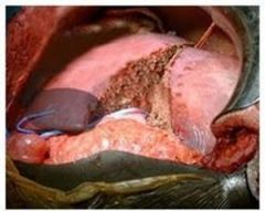 HEPATECTOMIE.jpg