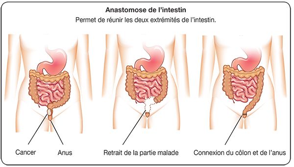 resection rectale.jpg