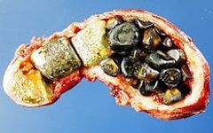 CALCULS vésicule biliaire