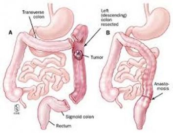 Chirurgie colorectale colectomie, résection rectum, colon