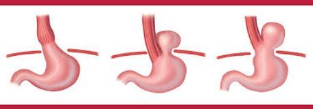 reflux.jpg