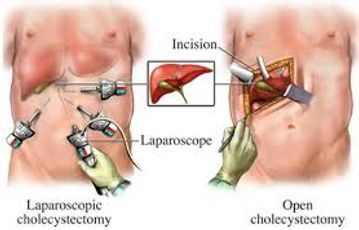 cholecystomie camera.jpg