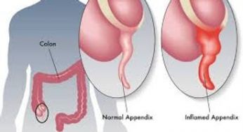 Appendicite.jpg