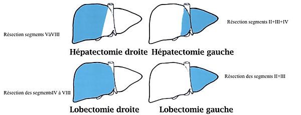 LOBECTOMIE HEPATIQUE.jpg
