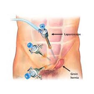Chirurgie de la hernie ombilicale inguinale abdominale