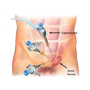 hernie surgery laparoscopie.jpg