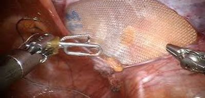 chirurgie hernie.jpg