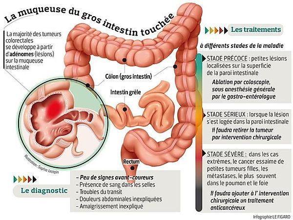 cancer-colon.jpg