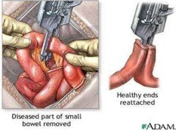 resection.jpg