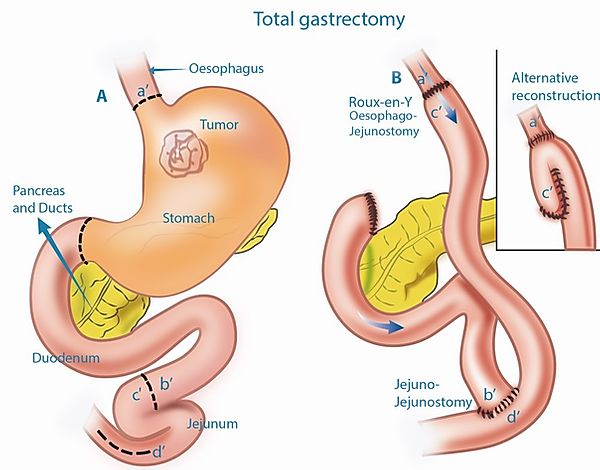 gastrectomie.jpg