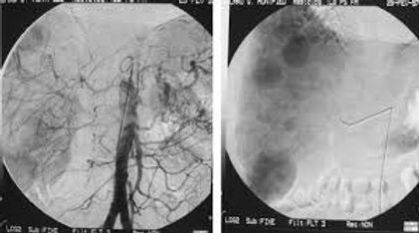 CHIMIOTHERAPIE.jpg