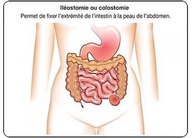 colostome.jpg