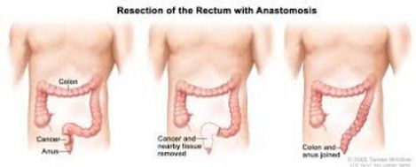 rectum.jpg