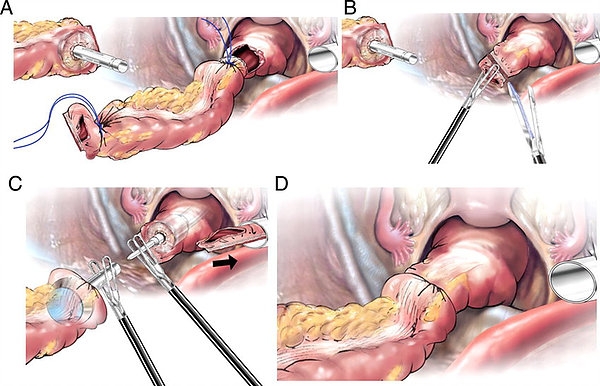 colon resection mini invasive.png