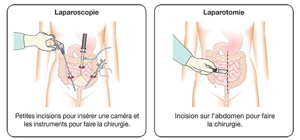 colectomie par laparoscopie.jpg