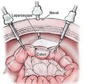 colectomie el moussaoui.jpg