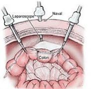 colectomie el moussaoui.jpg