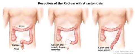 rectum.jpg