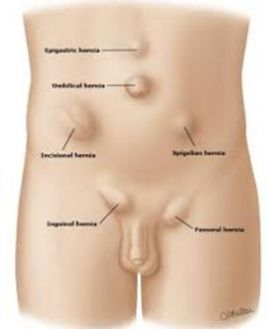 types hernie.jpg